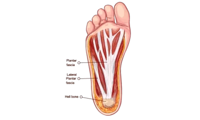 Plantar Fasciitis Pain Management - Propel Physiotherapy