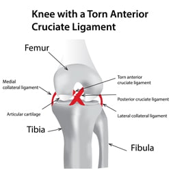 ACL/PCL Sprain/Tear