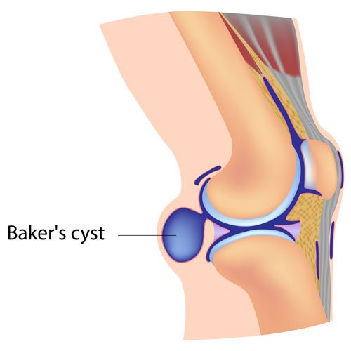 Baker's Cyst