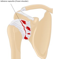 Frozen Shoulder (Adhesive Capsulitis)