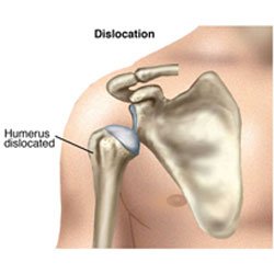 Dislocated & Subluxed Shoulder