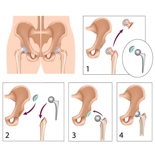 Hip Surgery | Replacement